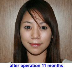 plastic-surgery-chin-augmentation